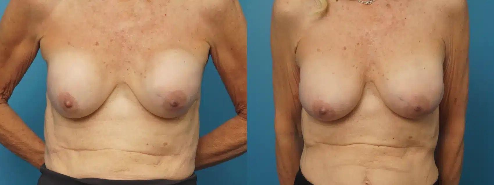 Mark Sisco, MD breast augmentation revision result — Northbrook, IL
