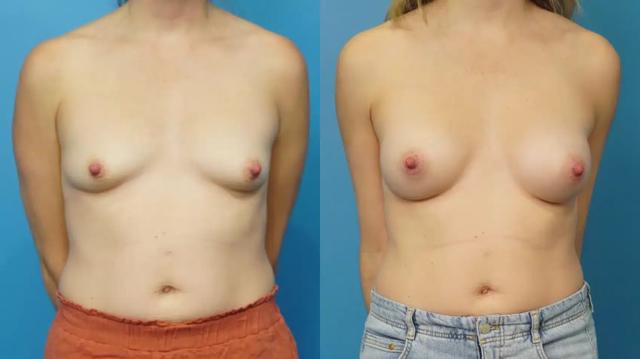 Breast Augmentation result at Mark Sisco, MD in Northbrook, IL