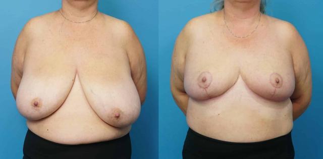 Breast Reduction result at Mark Sisco, MD in Northbrook, IL