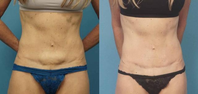 Tummy Tuck result at Mark Sisco, MD in Northbrook, IL