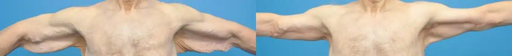 Mark Sisco, MD arm lift result — Northbrook, IL