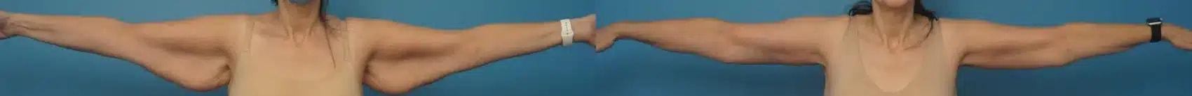 Mark Sisco, MD arm lift result — Northbrook, IL