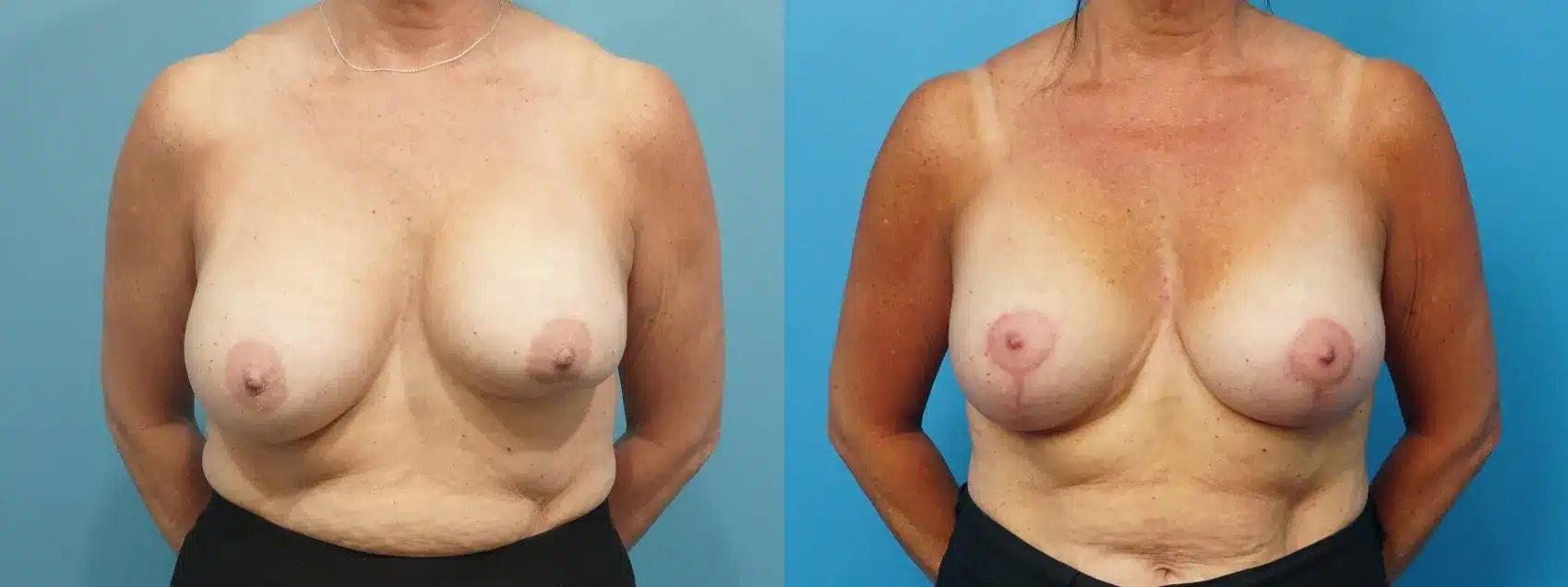 Mark Sisco, MD breast augmentation revision result — Northbrook, IL