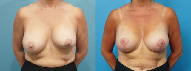 Breast Augmentation result at Mark Sisco, MD in Northbrook, IL