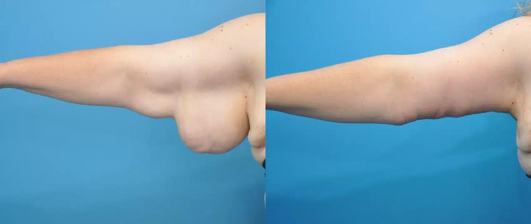 Mark Sisco, MD arm lift result — Northbrook, IL