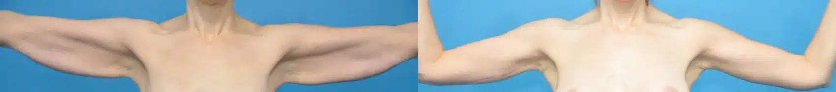 Mark Sisco, MD arm lift result — Northbrook, IL