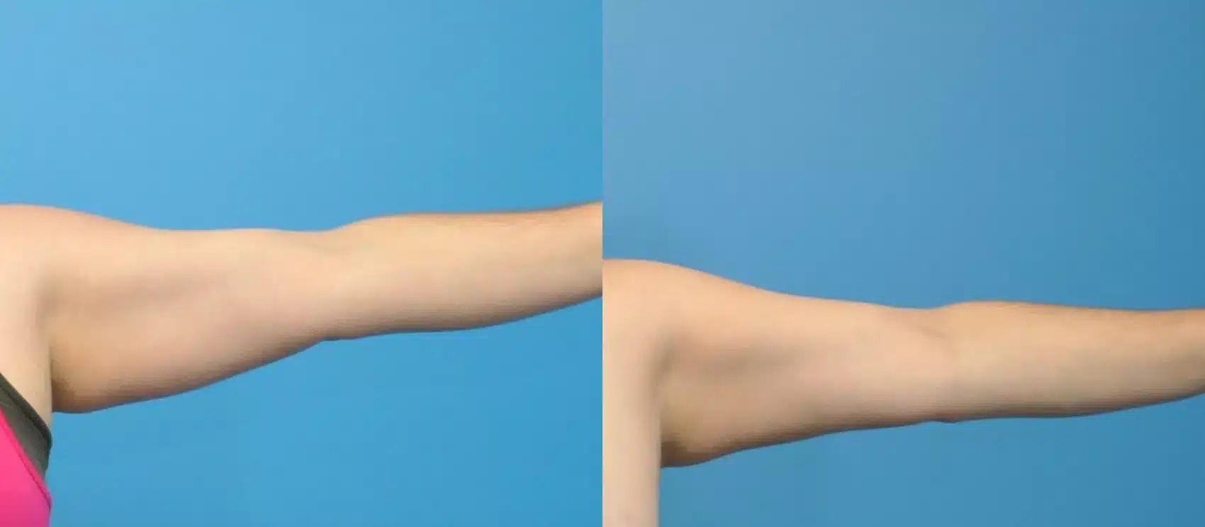 Mark Sisco, MD liposuction result — Northbrook, IL