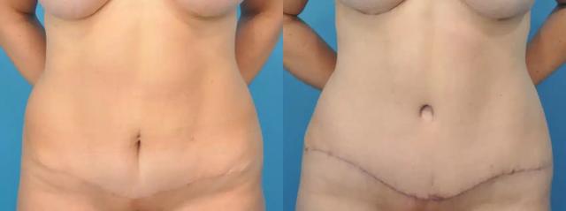 Tummy Tuck result at Mark Sisco, MD in Northbrook, IL