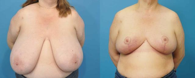 Breast Reduction result at Mark Sisco, MD in Northbrook, IL