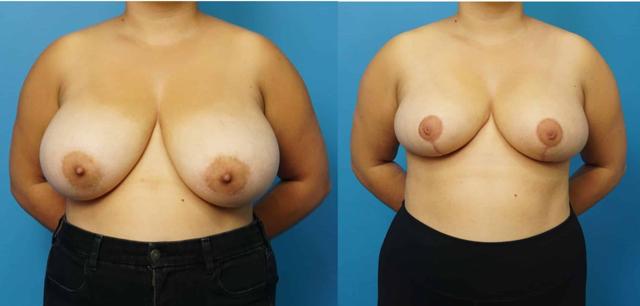 Breast Reduction result at Mark Sisco, MD in Northbrook, IL