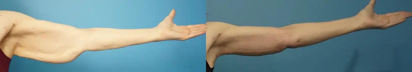 Mark Sisco, MD arm lift result — Northbrook, IL