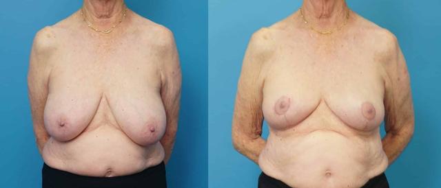 Breast Reduction result at Mark Sisco, MD in Northbrook, IL