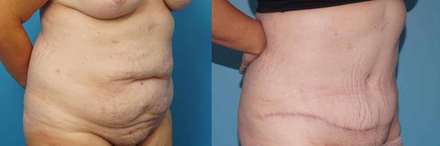 Tummy Tuck result at Mark Sisco, MD in Northbrook, IL