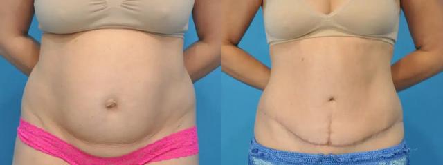 Tummy Tuck result at Mark Sisco, MD in Northbrook, IL