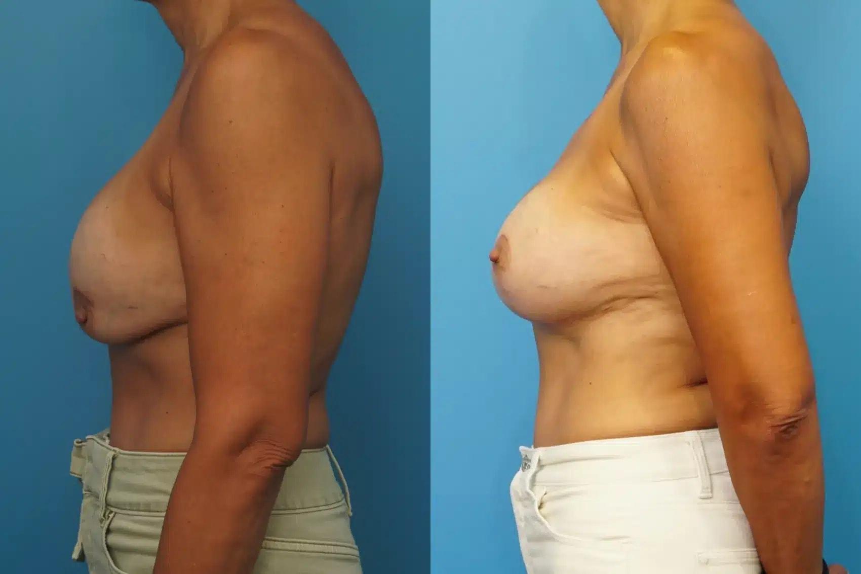 Mark Sisco, MD breast augmentation revision result — Northbrook, IL