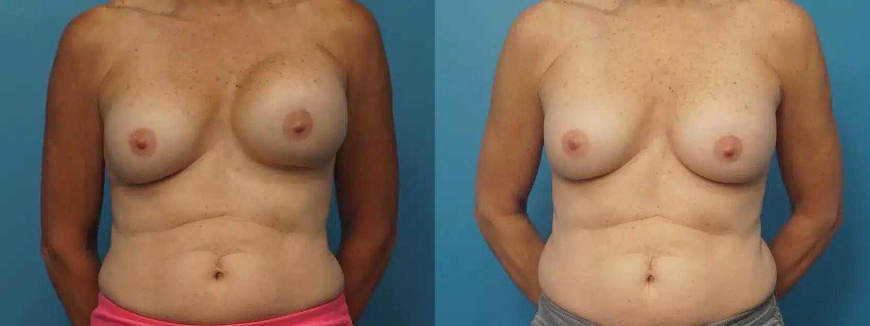 Mark Sisco, MD breast augmentation revision result — Northbrook, IL