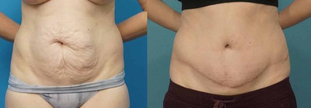 Tummy Tuck result at Mark Sisco, MD in Northbrook, IL