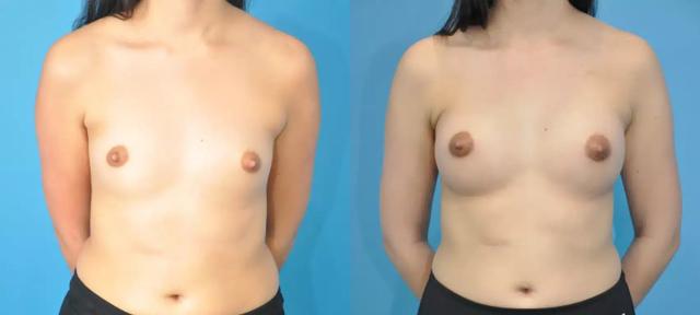Breast Augmentation result at Mark Sisco, MD in Northbrook, IL