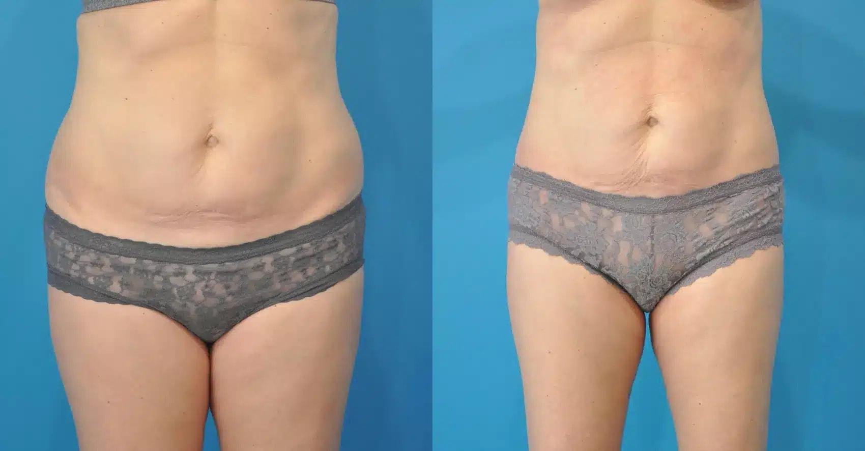 Mark Sisco, MD liposuction result — Northbrook, IL