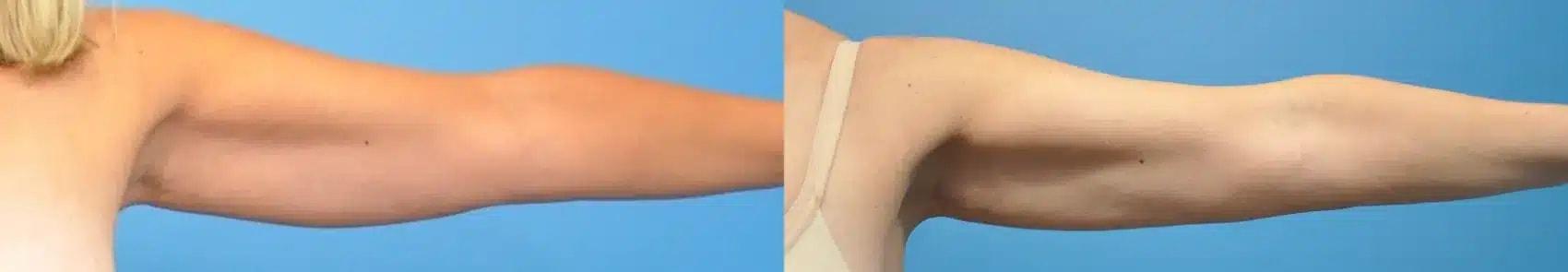 Mark Sisco, MD liposuction result — Northbrook, IL