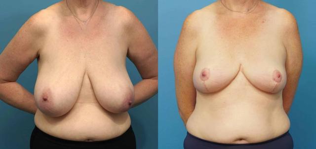 Breast Reduction result at Mark Sisco, MD in Northbrook, IL