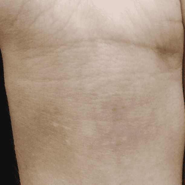 Miami Skin Spa Aesthetics & Wellness laser treatment after — Miami, FL