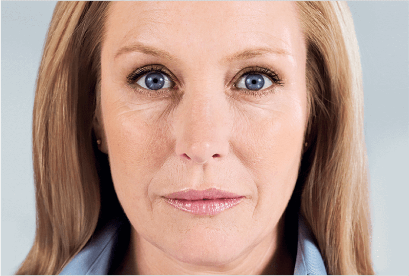 Miami Skin Spa Aesthetics & Wellness after — Miami, FL