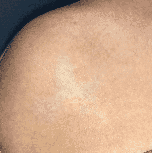 Laser Skin Resurfacing after at Miami Skin Spa Aesthetics & Wellness in Miami, FL
