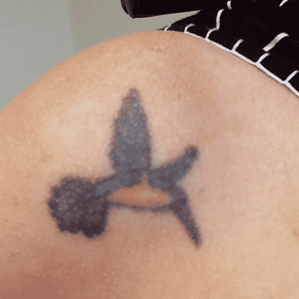Laser Skin Resurfacing before at Miami Skin Spa Aesthetics & Wellness in Miami, FL