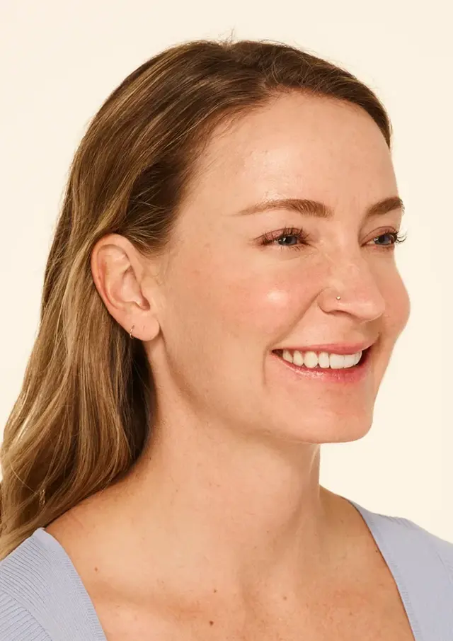 Botox after at Miami Skin Spa Aesthetics & Wellness in Miami, FL