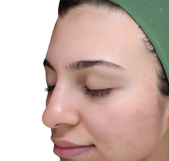 Laser Skin Resurfacing after at Miami Skin Spa Aesthetics & Wellness in Miami, FL