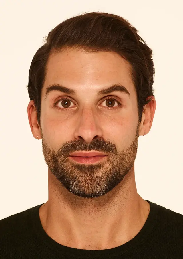 Botox after at Miami Skin Spa Aesthetics & Wellness in Miami, FL