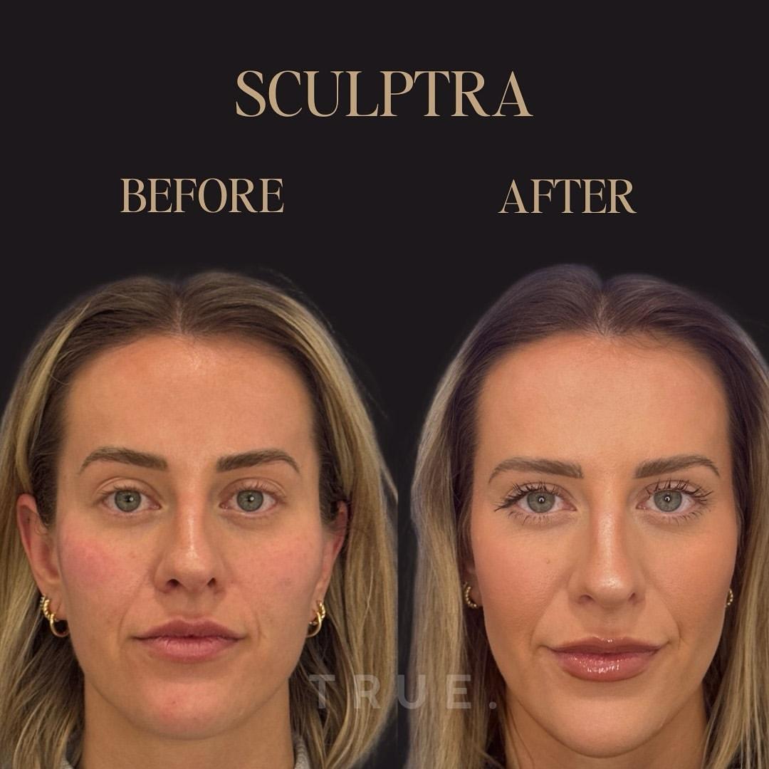 True Medical Spa cheek filler result — Draper, UT