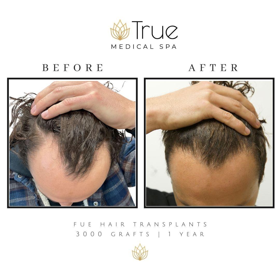 True Medical Spa fue hair transplant result — Draper, UT
