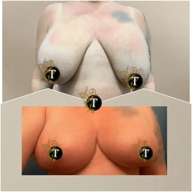 Breast Augmentation result at Dr. Tran Cosmetics in Aventura, FL
