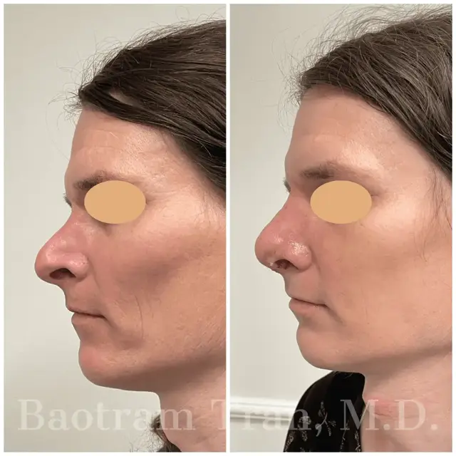 Rhinoplasty result at Dr. Tran Cosmetics in Aventura, FL