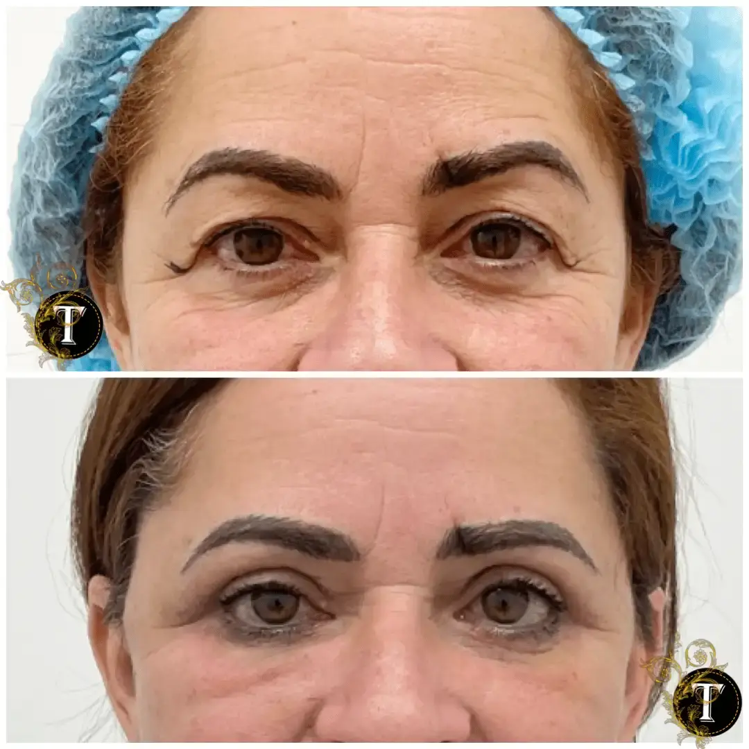 Dr. Tran Cosmetics blepharoplasty result — Aventura, FL