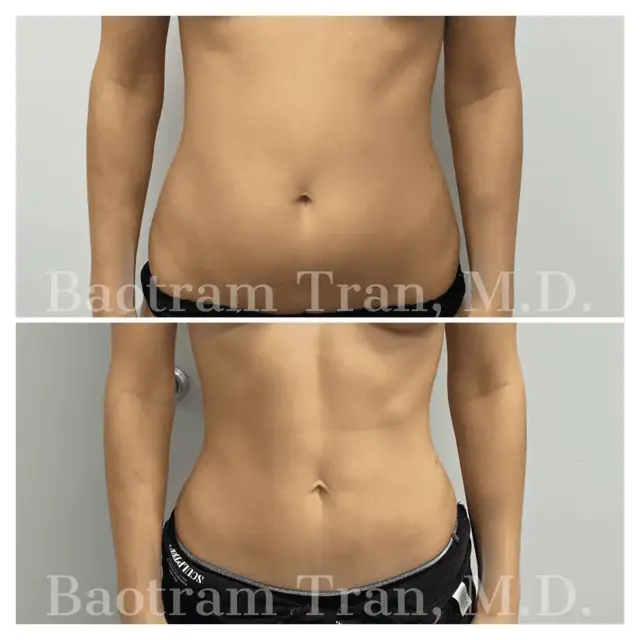 Liposuction result at Dr. Tran Cosmetics in Aventura, FL