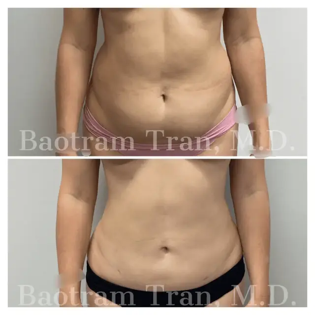 Liposuction result at Dr. Tran Cosmetics in Aventura, FL