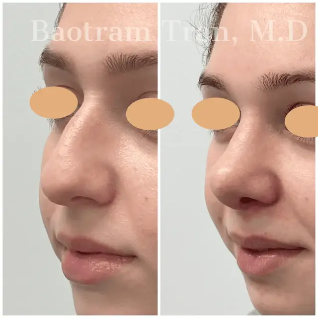 Rhinoplasty result at Dr. Tran Cosmetics in Aventura, FL
