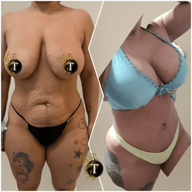 Breast Augmentation result at Dr. Tran Cosmetics in Aventura, FL