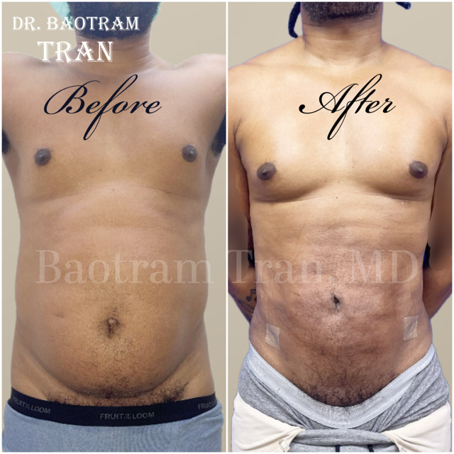Liposuction result at Dr. Tran Cosmetics in Aventura, FL