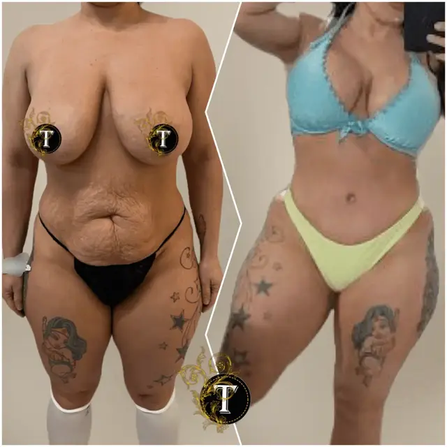 Tummy Tuck result at Dr. Tran Cosmetics in Aventura, FL
