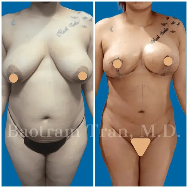 Mommy Makeover result at Dr. Tran Cosmetics in Aventura, FL