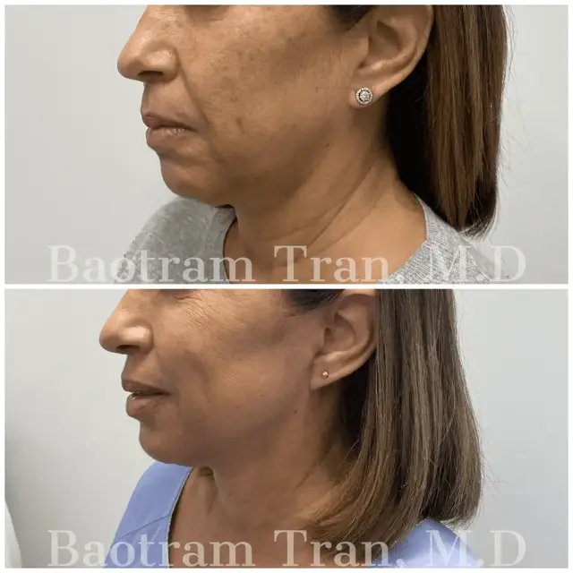 Facelift result at Dr. Tran Cosmetics in Aventura, FL