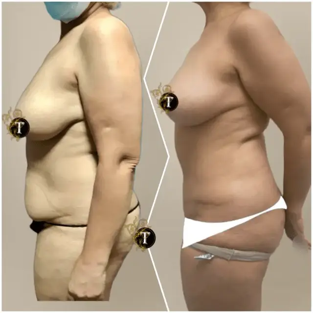 Tummy Tuck result at Dr. Tran Cosmetics in Aventura, FL