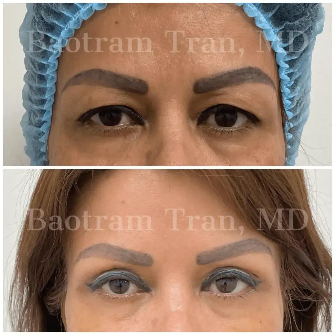 Dr. Tran Cosmetics blepharoplasty result — Aventura, FL