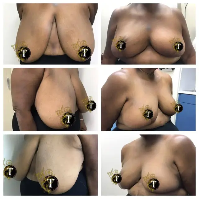 Breast Reduction result at Dr. Tran Cosmetics in Aventura, FL