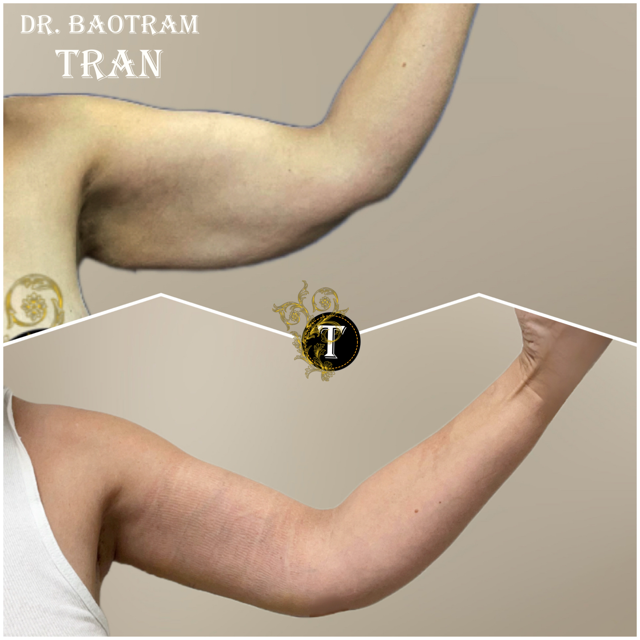 Arm Lift result at Dr. Tran Cosmetics in Aventura, FL