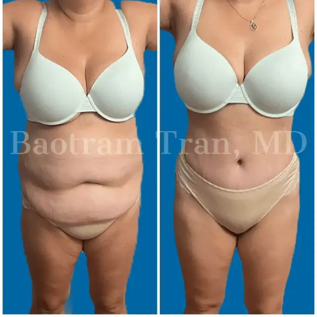 Tummy Tuck result at Dr. Tran Cosmetics in Aventura, FL